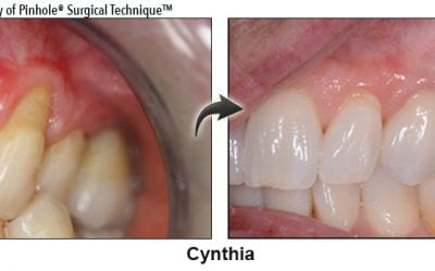 Dr. Sedki Now Offers the Pinhole Surgical Technique!