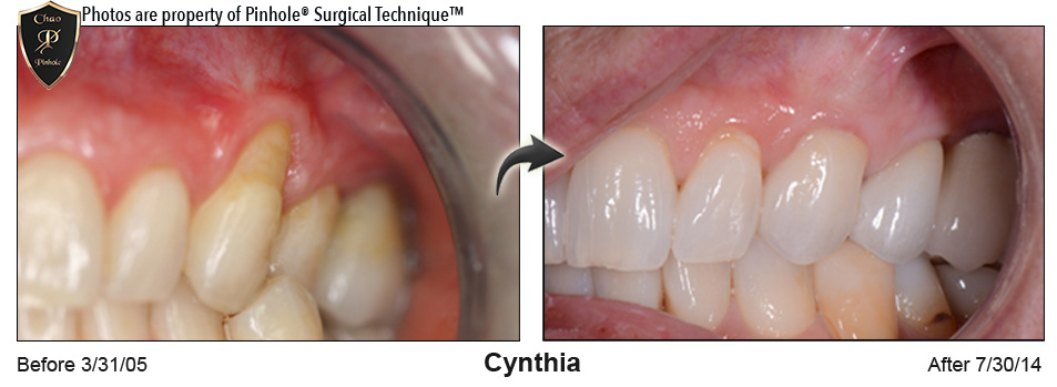 Pinhole Surgical Technique and Pinhole Gum Rejuvenation