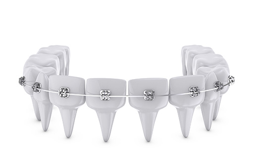 Dental Braces in Pontiac MI