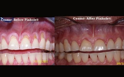 Signs of Gum Recession and What to Do About It