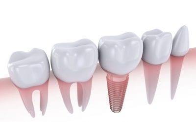 What are Dental Implants?